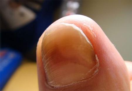 指甲增厚变色一定是灰指甲吗图片,指甲变空了发黄是灰指甲的图