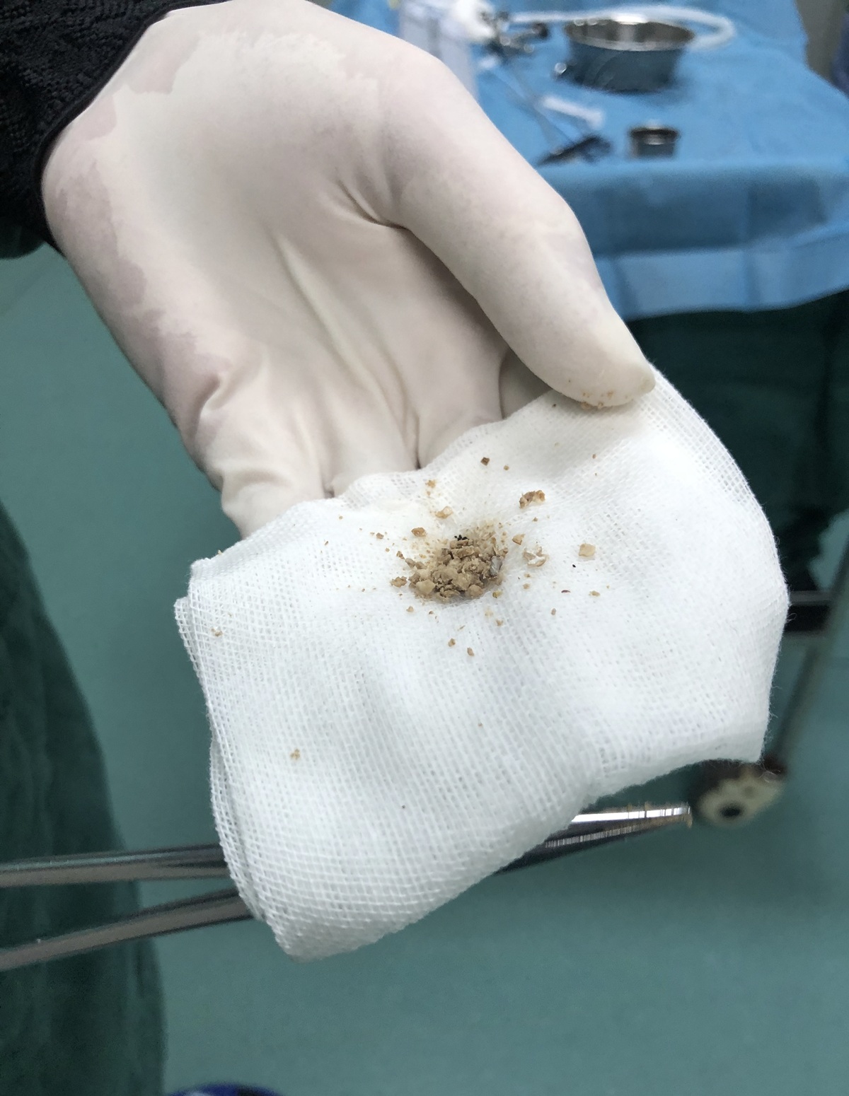 肾结石与肾结晶有何区别,肾结晶和结石有什么区别