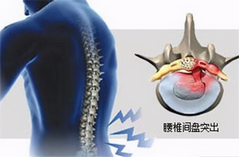 青岛伍龙铁腰板靠谱吗,伍龙科技铁腰板腰突治疗仪