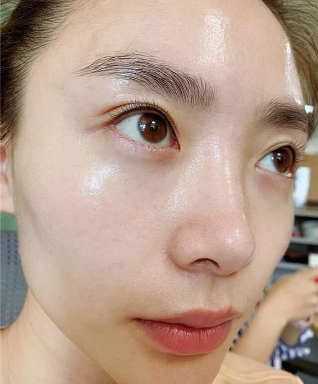 额头闭口和下巴闭口如何去除,下巴长闭口粉刺怎么去除小妙招