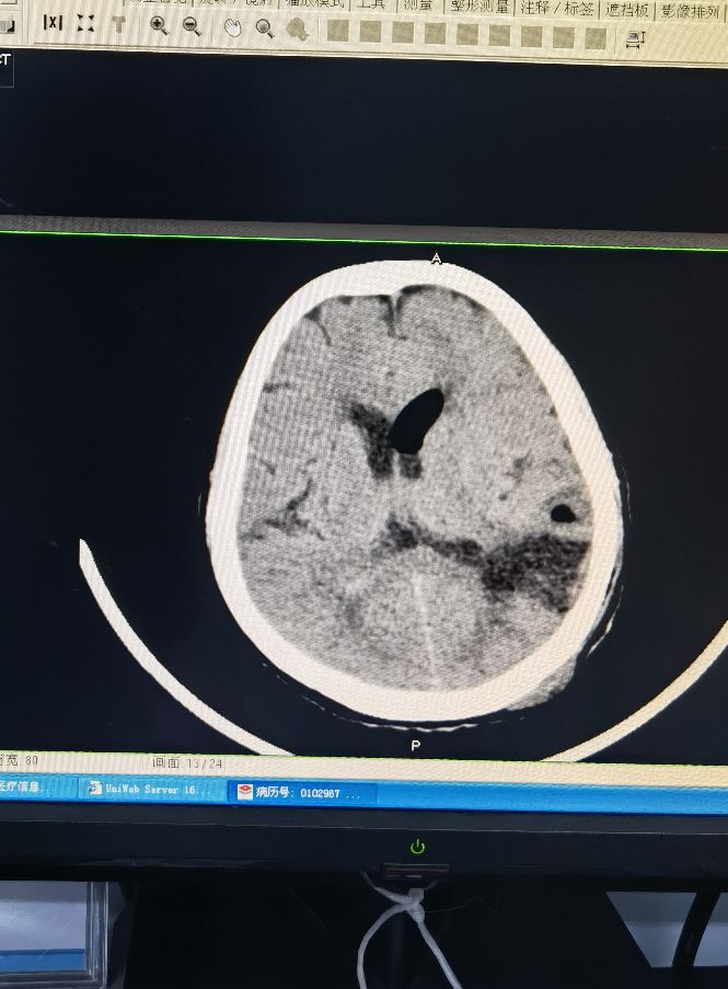 硬脑膜外血肿引流,高压氧治疗颅内出血