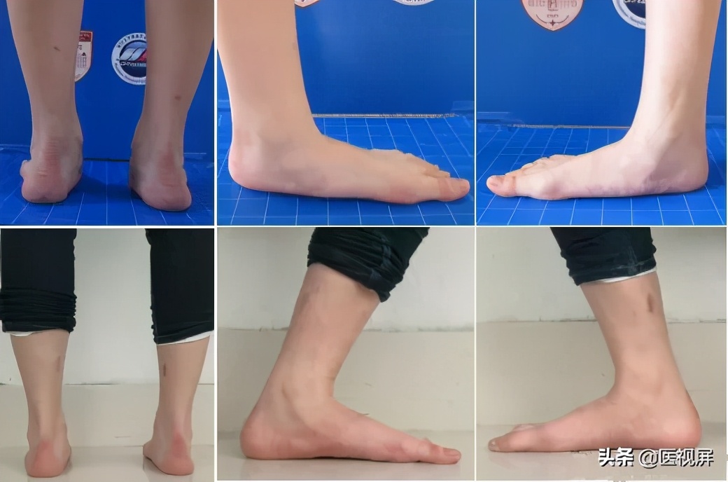 17岁平足症怎么治疗,青少年平足怎么办