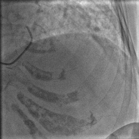 85岁老人心脏堵塞,77岁老人冠脉狭窄放支架还是搭桥