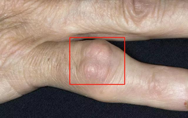 60多岁痛风有痛风石吃什么药,痛风十多年没长痛风石是什么原因