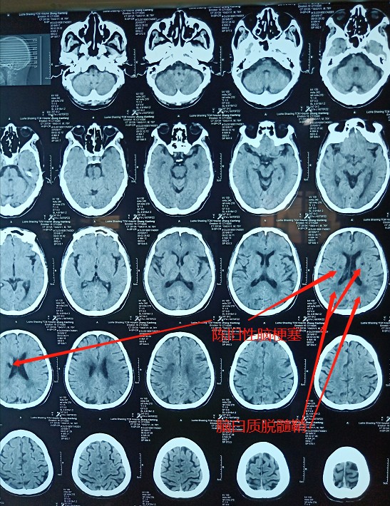 手指麻木不一定是颈椎病