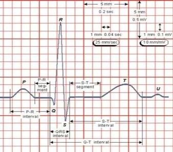 儿童阵发性室上心动过速,儿童阵发性室上性心动过速