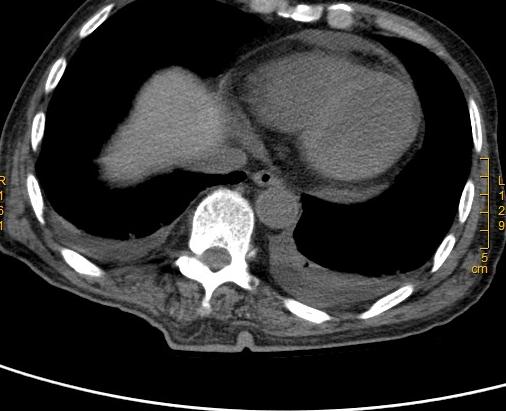 甲减病人一般甲减正常值能活多久,甲减的表现症状和甲减危害