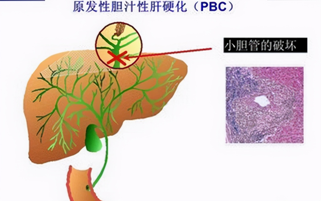 肝硬化健康教育微视频,健康养生知识肝硬化