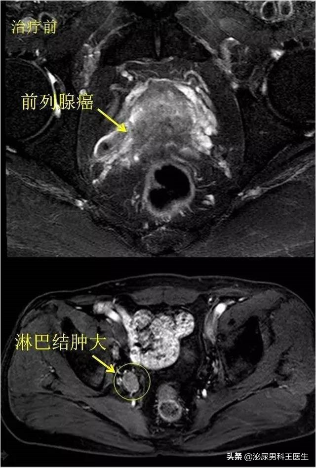为什么年轻人会得前列腺癌,为什么年轻人会得前列腺炎