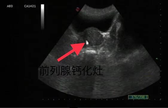 前列腺钙化灶可以用冲击波治疗吗,治疗前列腺钙化灶的药物有哪些