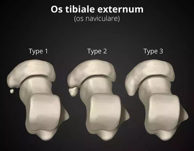 副舟骨疼痛是什么原因引起,副舟骨突出明显是什么原因