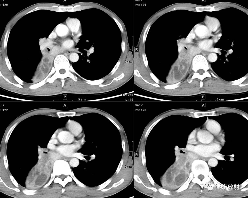 x线诊断边界模糊,x线诊断有误区吗