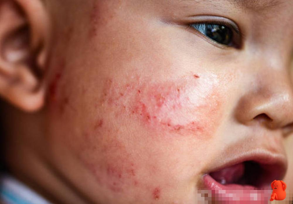 夏季宝宝脸蛋红并粗糙怎么样缓解,宝宝皮肤薄怎么改善