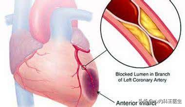冠心病腿肿利尿药有用吗,冠心病腿肿就是心衰吗