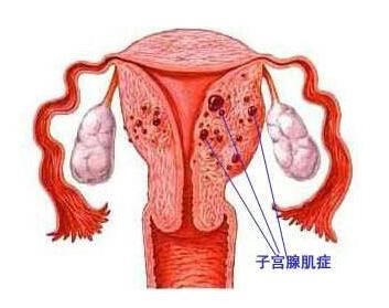 湿热瘀阻致经期延长痛经,痛经时间越来越长怎么回事