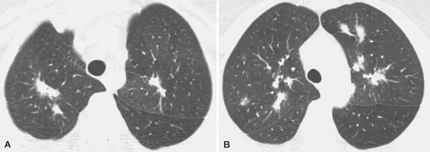 机化性肺炎平时应注意什么,机化性肺炎的正规治疗