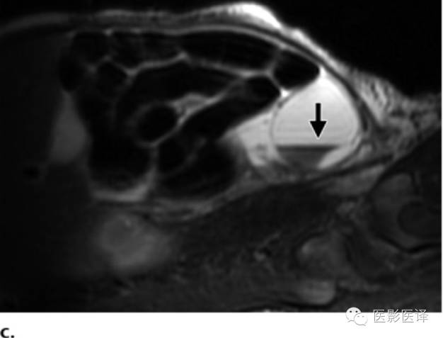 胎儿卵巢囊肿5.6厘米会消失吗,卵巢巨大囊肿与妊娠鉴别