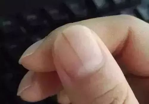 指甲全是竖条纹和白点是怎么回事,指甲竖条纹没有月牙怎么回事