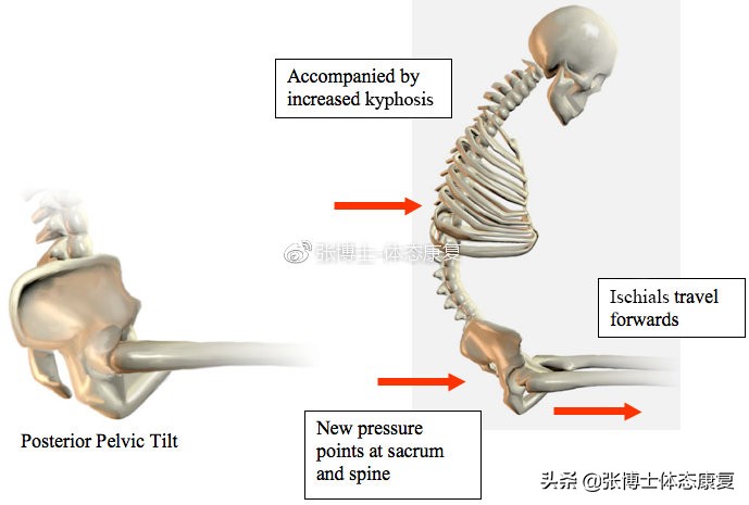 【体态矫正】骨盆后倾的形成原因与矫正训练