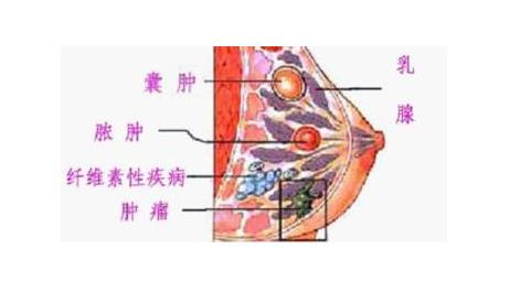 乳房纤维腺瘤可以正常哺乳吗,乳房纤维腺瘤6公分要手术吗