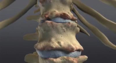 b27阴性的强直性脊柱炎有什么症状,强直性脊柱炎的症状是什么引起的