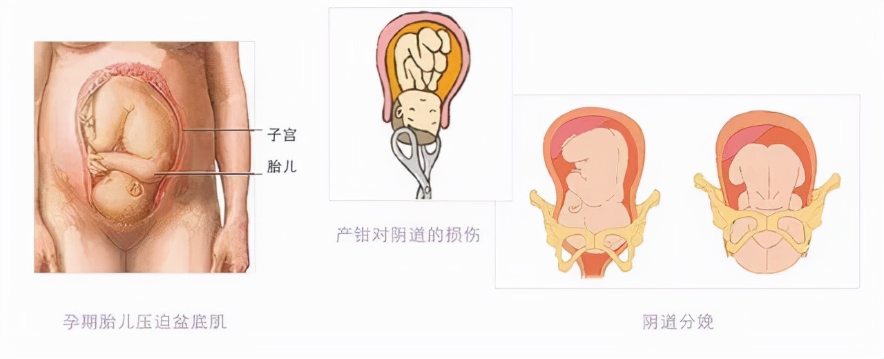 盆底康复凯格尔运动,盆底康复操视频教程