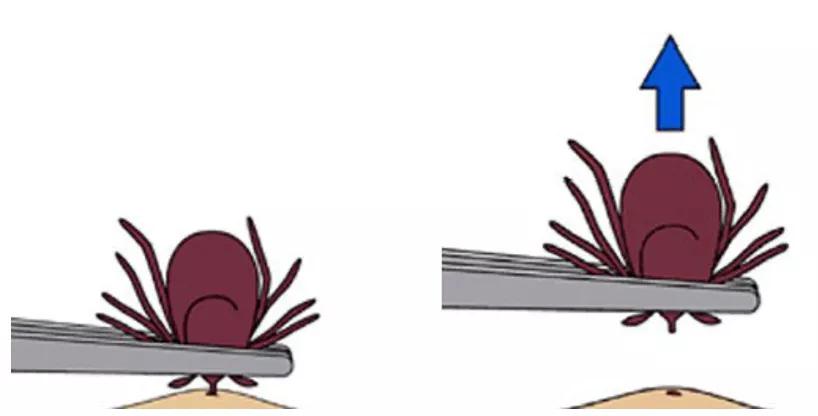 当心！假期出游警惕身体出现这样的小红点，严重或可致命