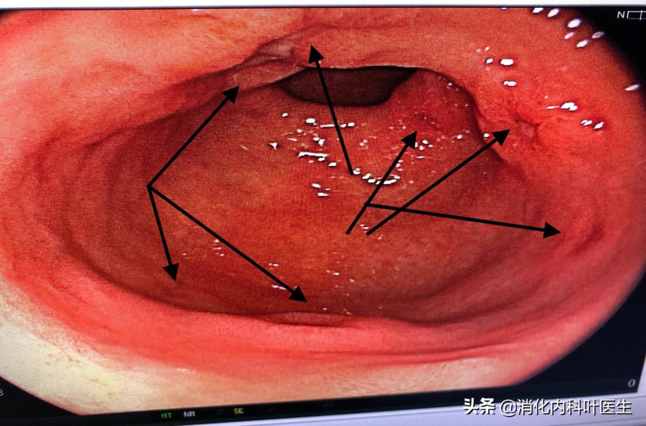 胃为什么吃得太饱就反酸顶气,胃为啥消化那么快