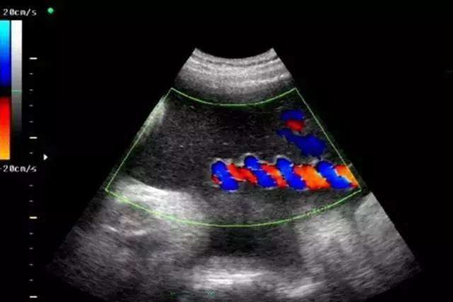 孕妇怀孕结果难产,怎么知道孕中晚期胎儿胎停