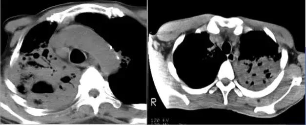 肺部ct十大征象,肺部ct正常图和异常图的区别