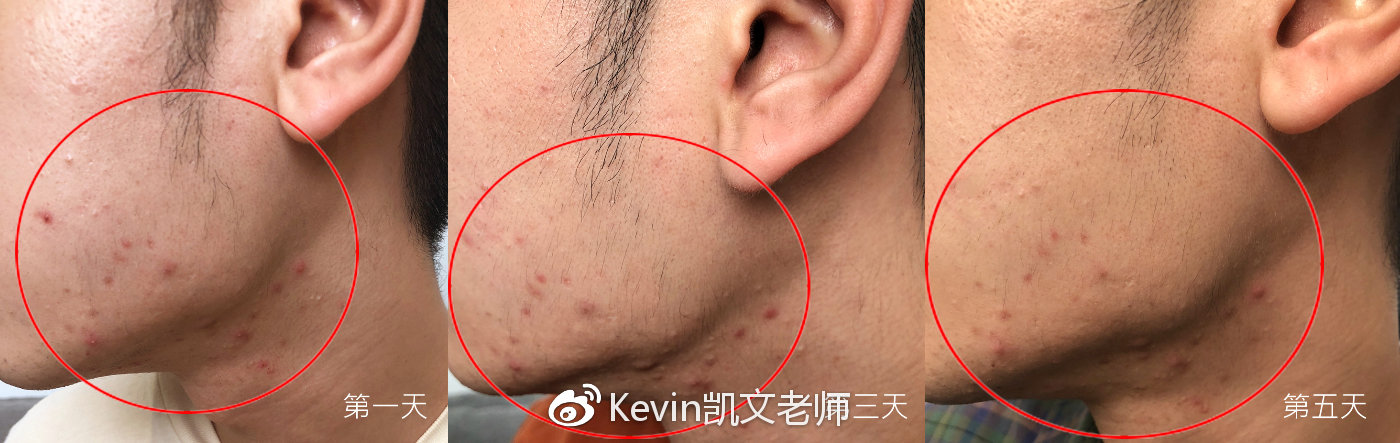 鏁忔劅鑲岀鐥樹竴濂楁姢鑲ゅ搧鎺ㄨ崘 (鏁忔劅鑲岀鐥樻姢鑲ゅ搧)