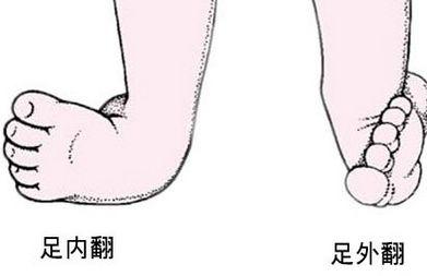 足内翻拇外翻是什么原因,足内翻足外翻的解决方法