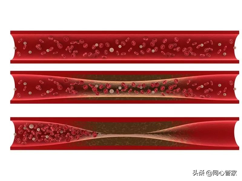 阿司匹林他汀药长期吃血管还堵吗,血管堵吃阿司匹林