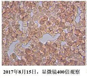 血液粘稠的病因及治疗,健康血液粘稠别小看但也别乱治