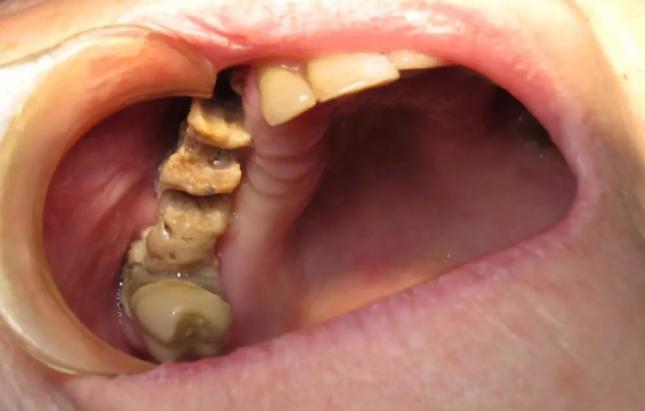 服用阿司匹林可以服丹参吗,服用阿司匹林能服用甲硝唑吗