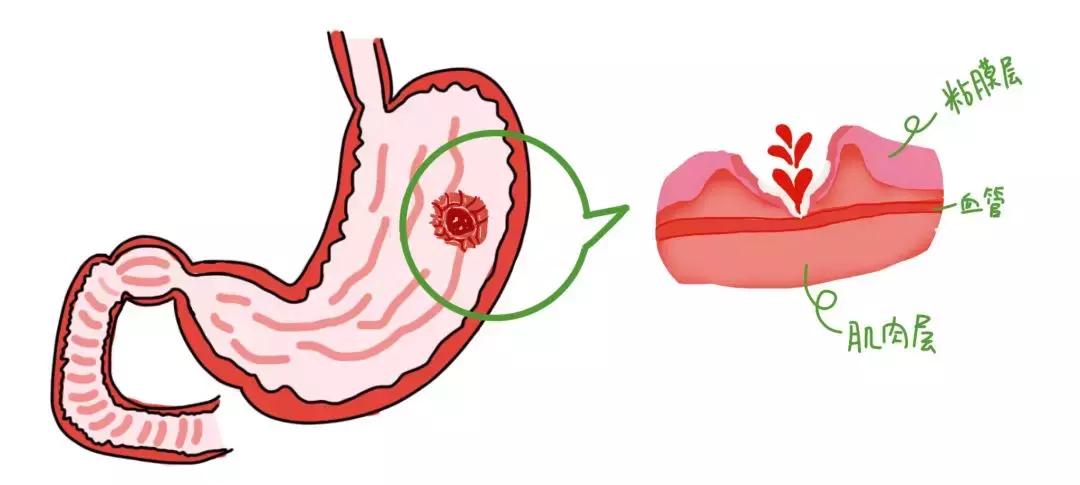 小林历险记二：胃镜大揭秘