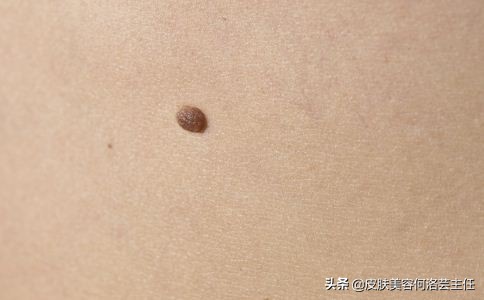 脸上有黑色素沉着斑怎能治好,脸上有色斑的护肤教程