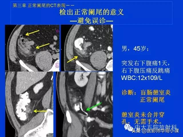阑尾炎课件,阑尾炎的超声课件