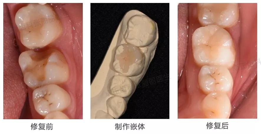 牙齿缺损全瓷冠修复多少钱,牙齿楔状缺损修复大概多少钱