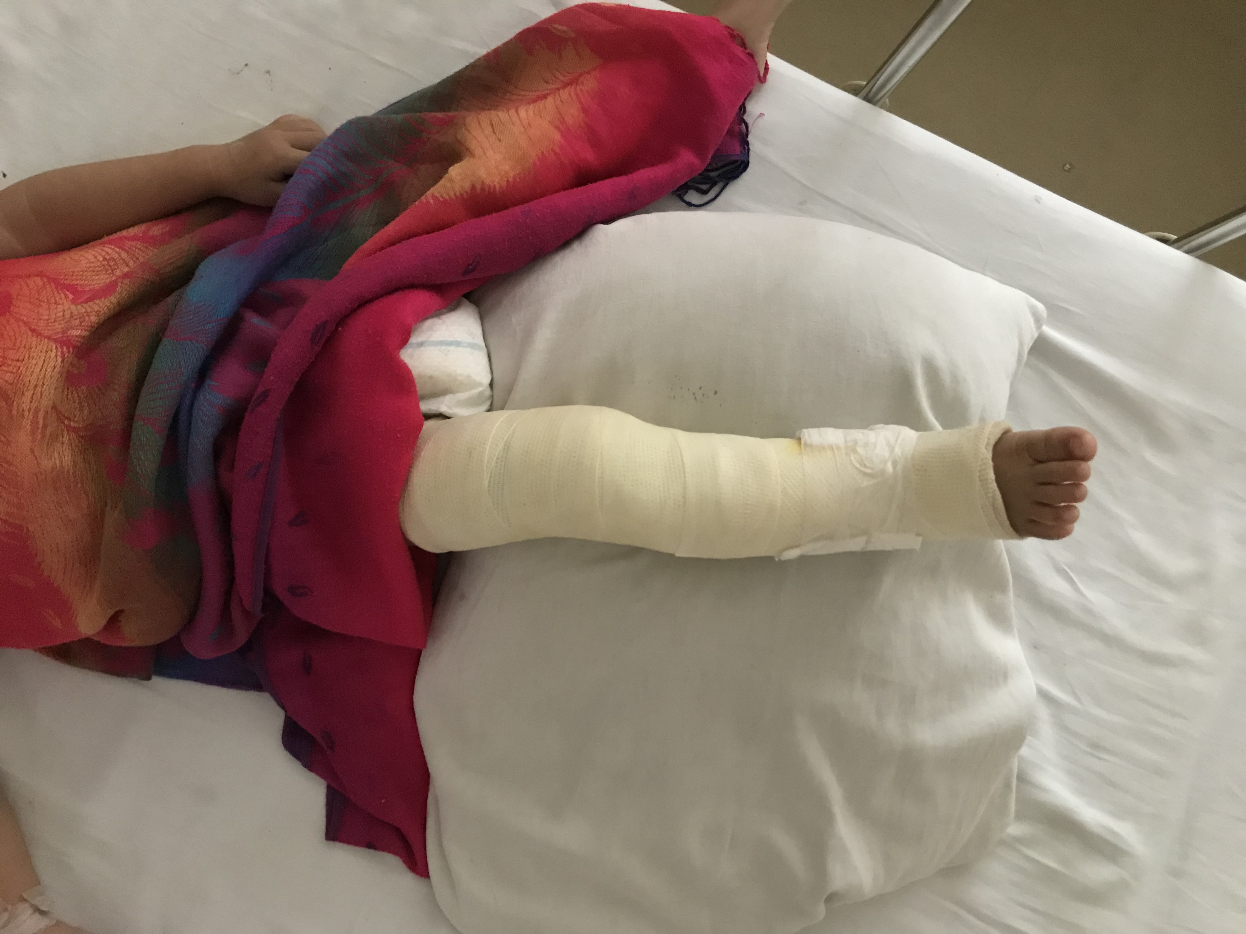 打石膏注意事项有哪些,打石膏有什么要注意的地方