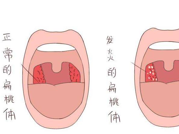 宝宝扁桃体炎一般什么原因引起,宝宝扁桃体发炎怎么引起的