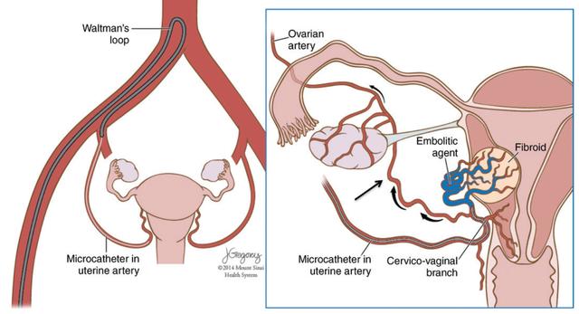 中晚期宫颈癌最佳方法,七十老人宫颈癌中晚期怎么治疗好