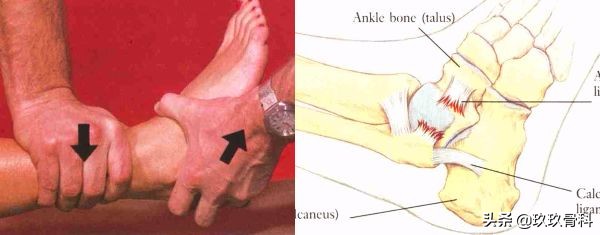 陈旧性踝关节损伤的治疗,踝关节损伤现场处理视频