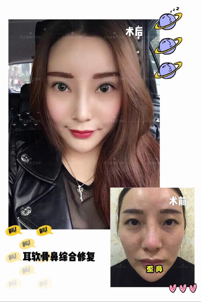 隆鼻手术十大常见问题的应对方案,隆鼻手术前应该准备带什么东西