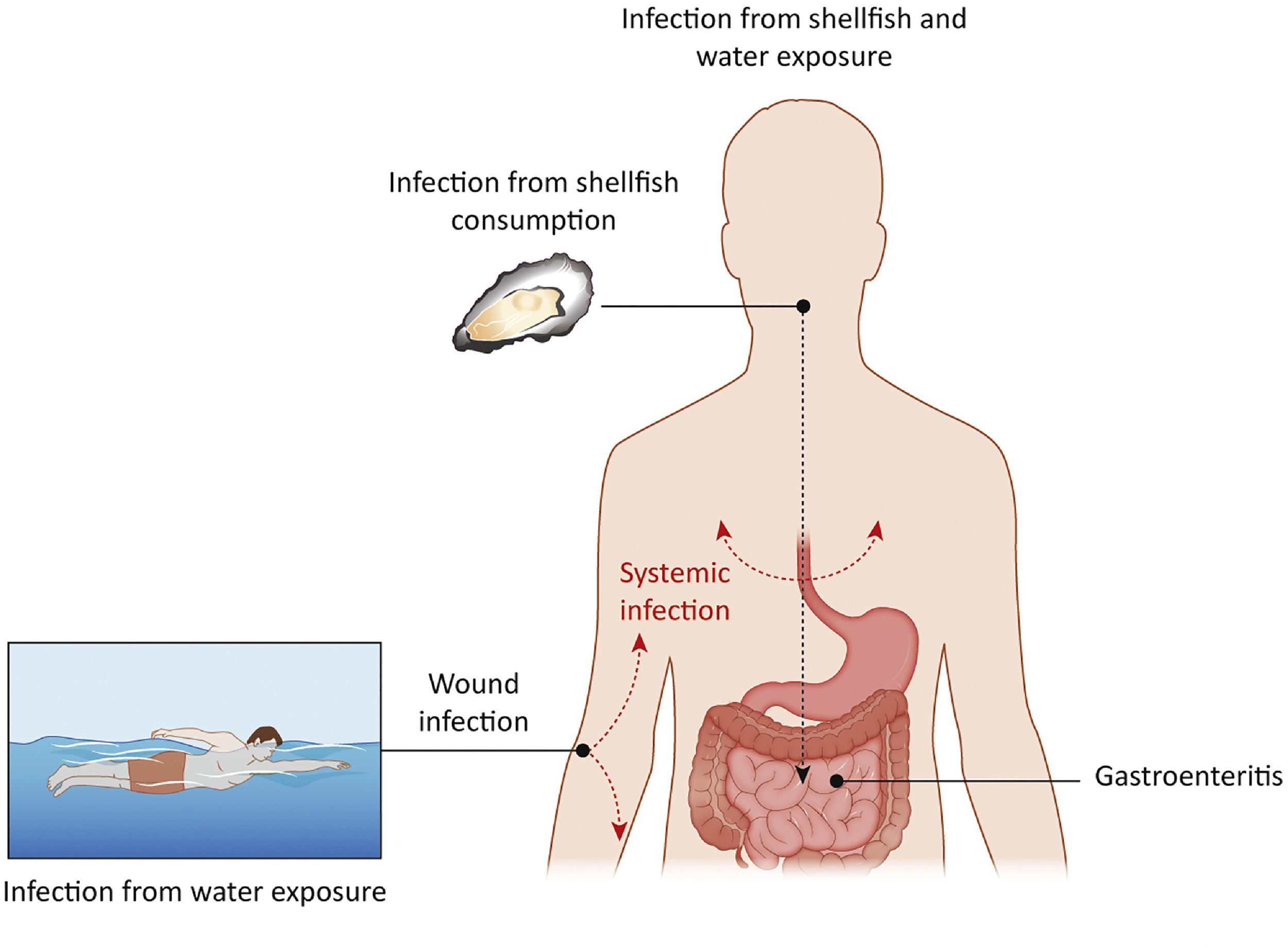 洗虾扎伤手老人被迫截肢保命,老人洗虾手指遭刺保命