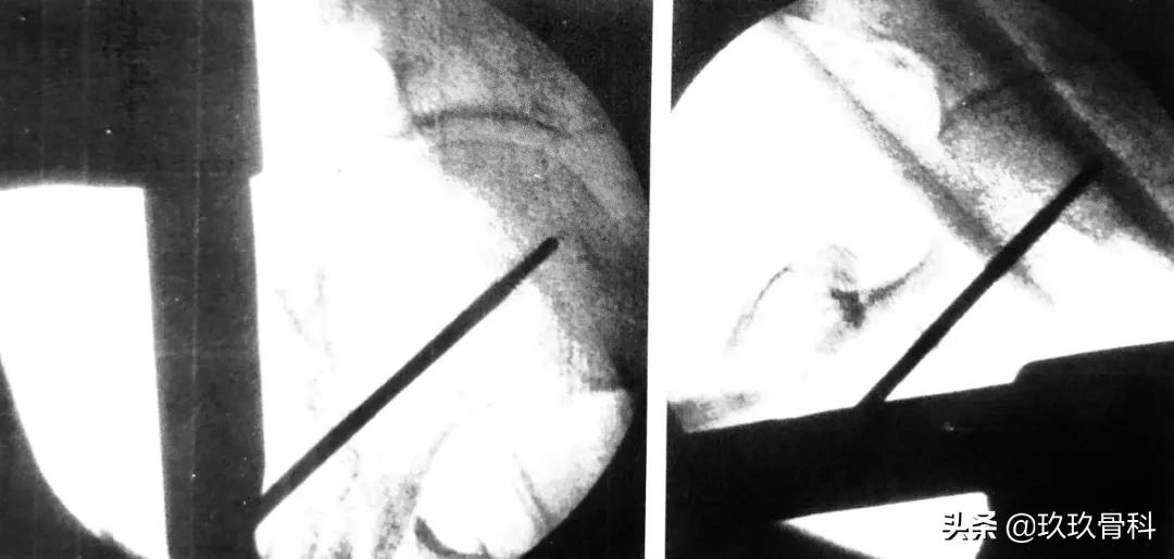 骨科用髓内钉什么材料,骨科髓内钉的作用