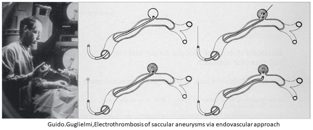 颅内动脉瘤血管栓塞治疗术后护理,颅内动脉瘤手术后血管渗血