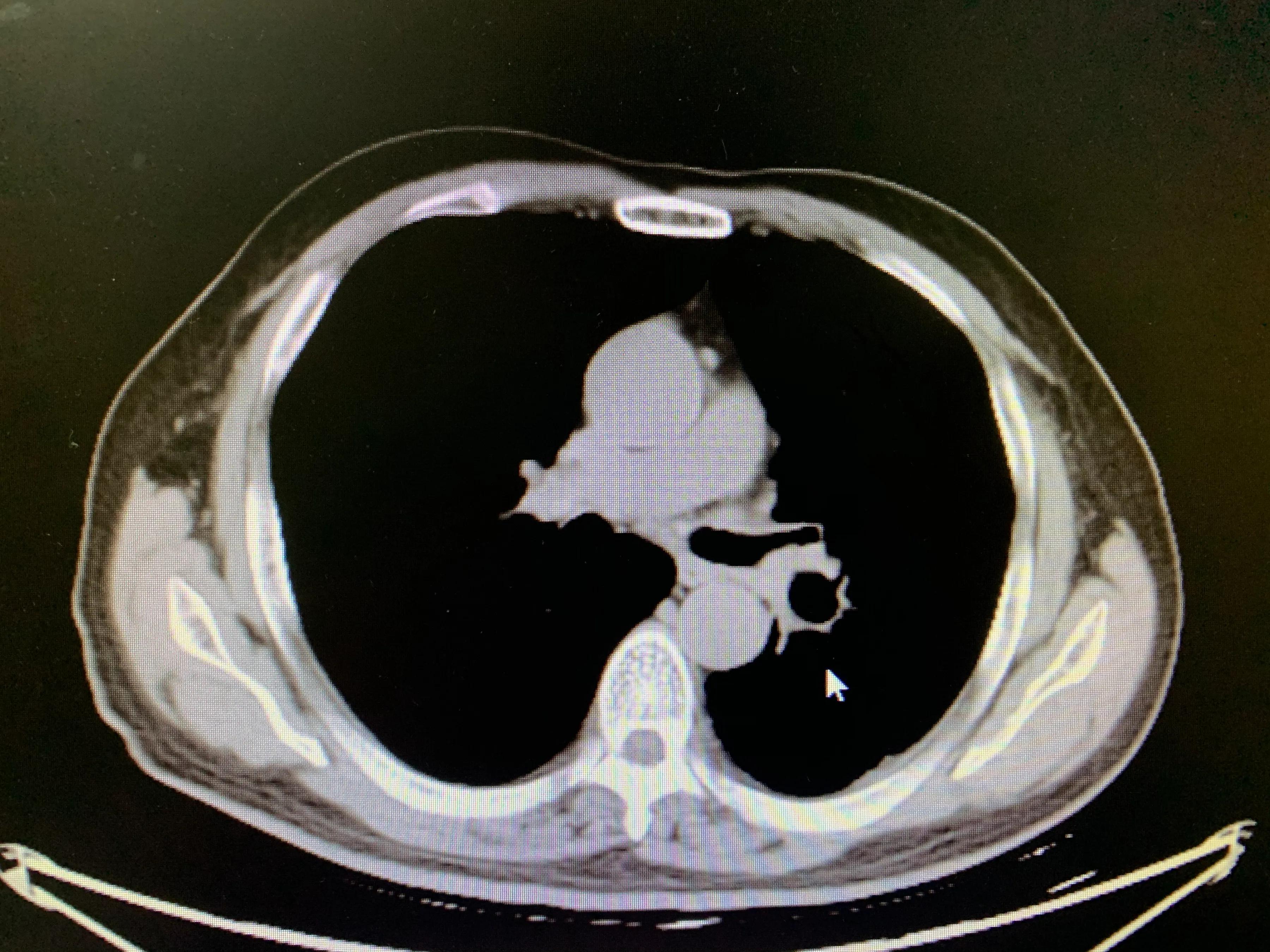 肺癌栓塞的介入治疗,84岁老人患肺癌可以做微创介入吗