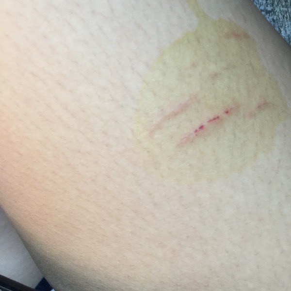 被自家养的猫咪抓伤和咬了出血了,被自己养的猫咪抓伤