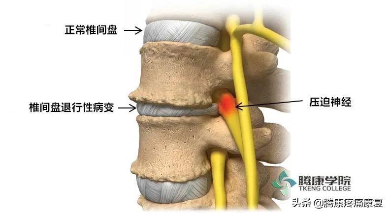 腰椎间盘退行性改变怎么治疗呢,腰椎退行性变和腰间盘突出哪个重